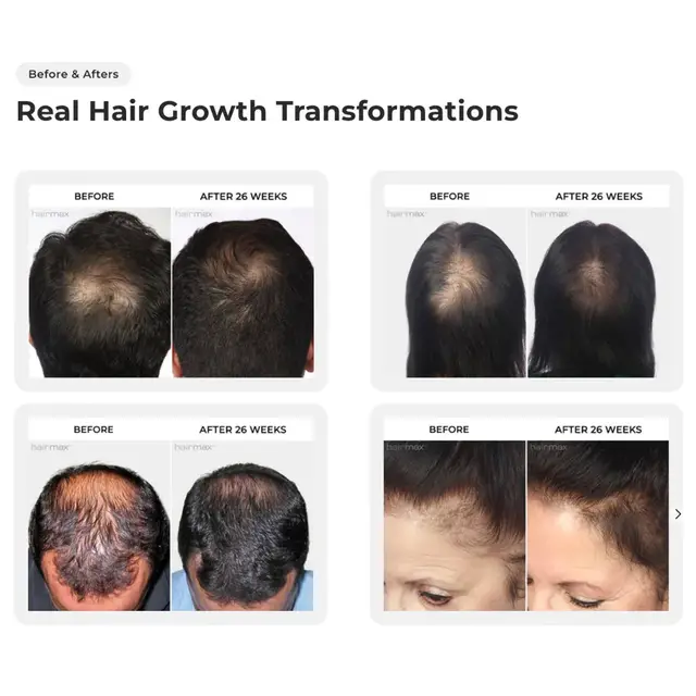 Hairmax product from CBS Deals